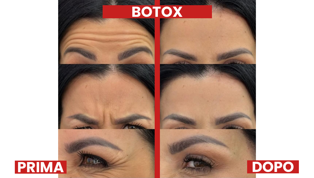 PRIMA-DOPO-BOTOX