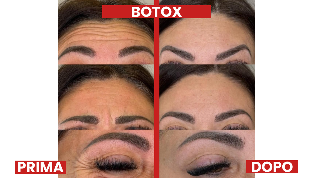 PRIMA-DOPO-BOTOX2