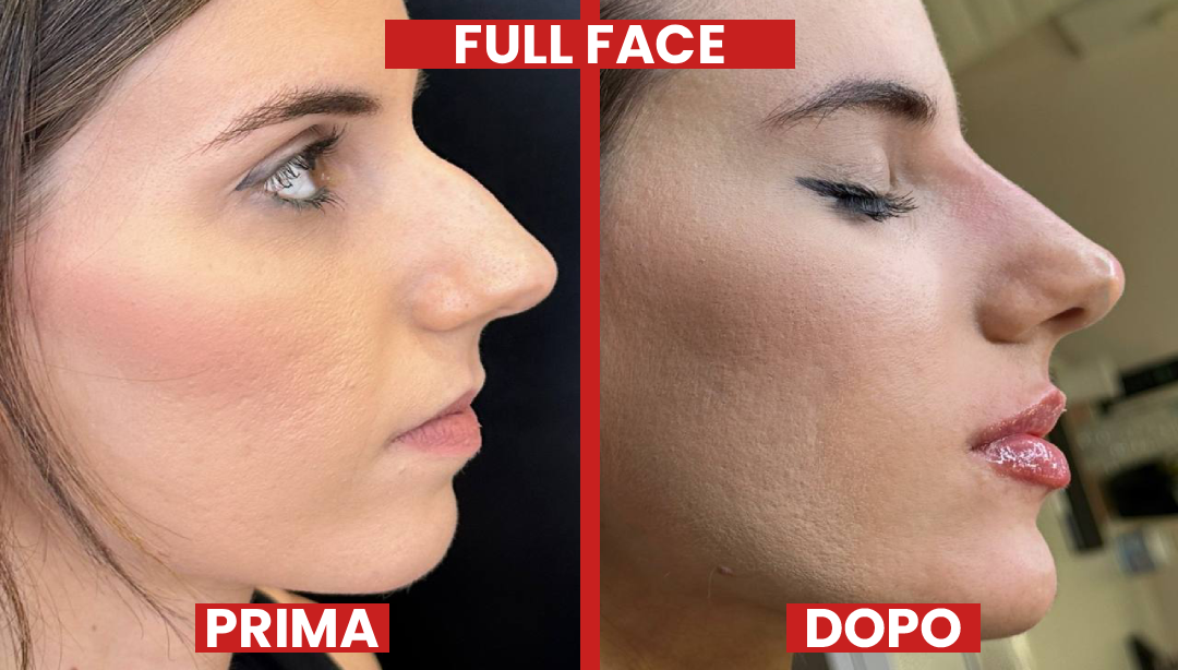Prima-dopo-FULLFACE