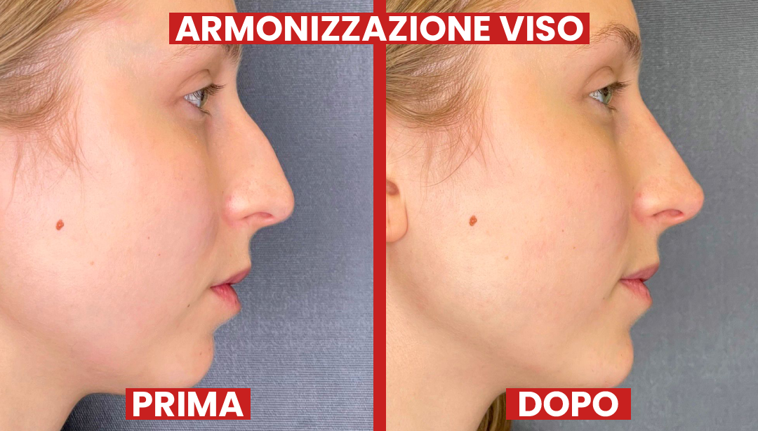 Prima-dopo-armonizzazione-laclinic