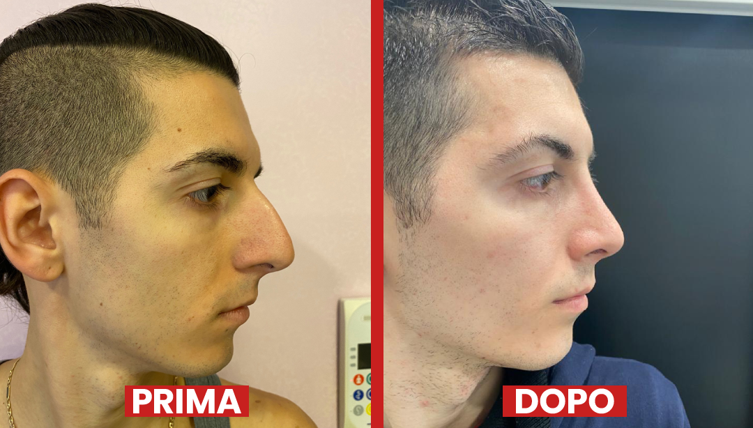 Prima-dopo-rinoplastica1