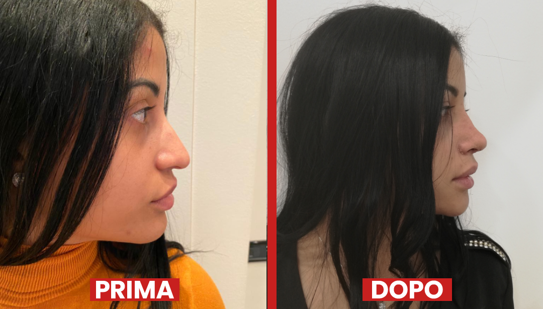 Prima-dopo-rinoplastica2