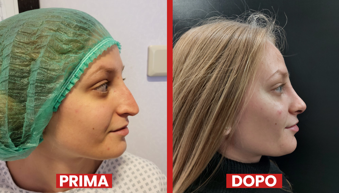 Prima-dopo-rinoplastica3