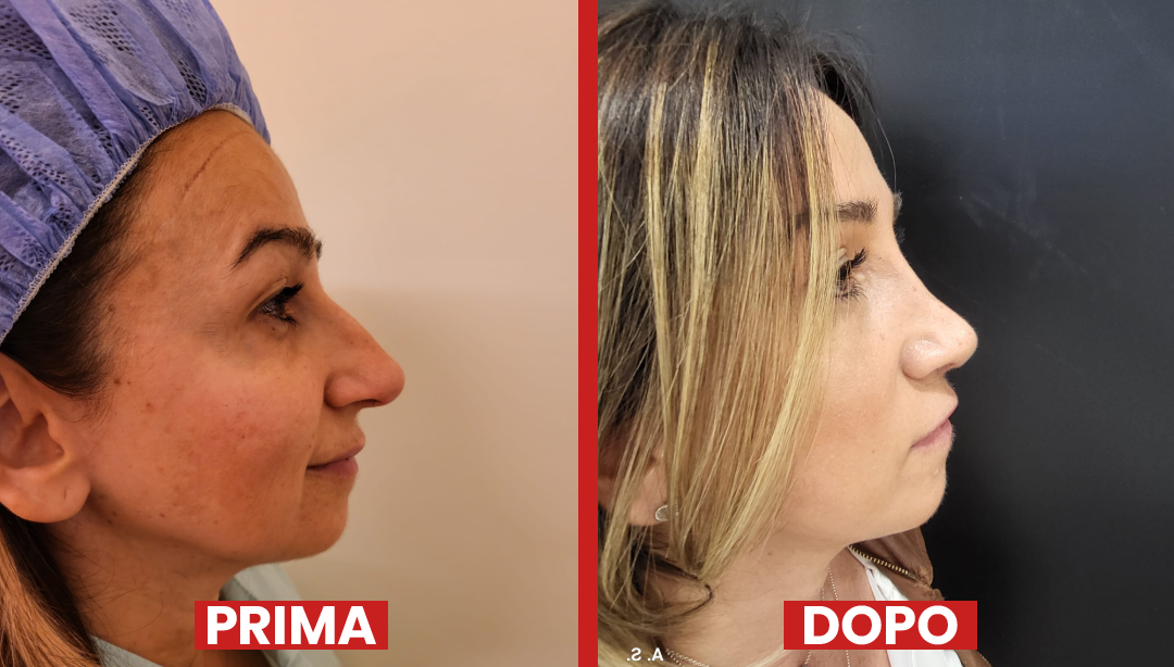 Prima-dopo-rinoplastica4