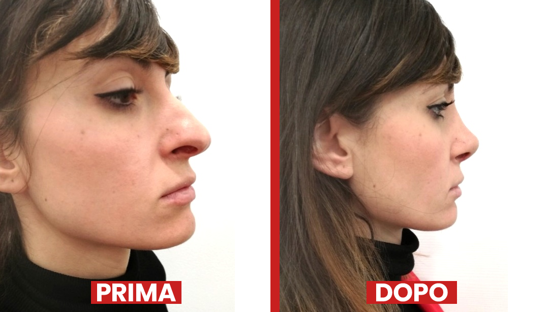 Prima-dopo-rinoplastica5