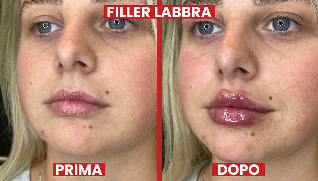 filler-prima-dopo-la-clinic