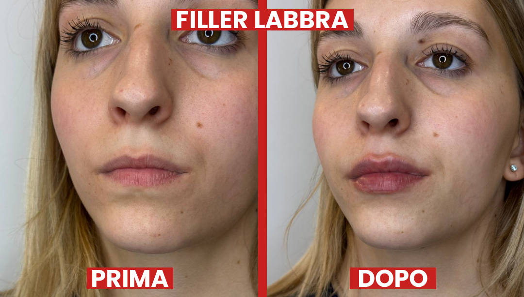 filler-prima-dopo-la-clinic2
